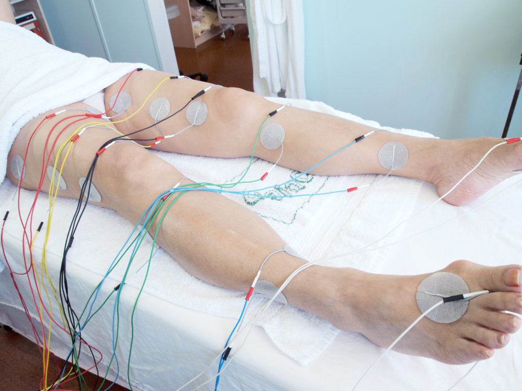 Body Cast Catheter
