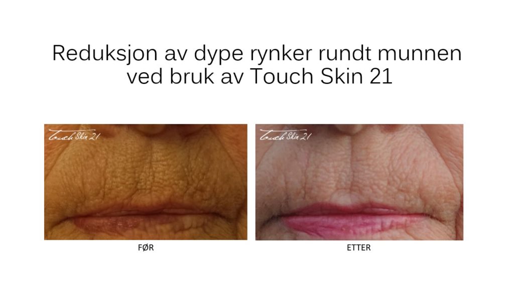 Touch Skin 21: Flott resultat etter 2 behandlinger av dype rynker rundt munnen.